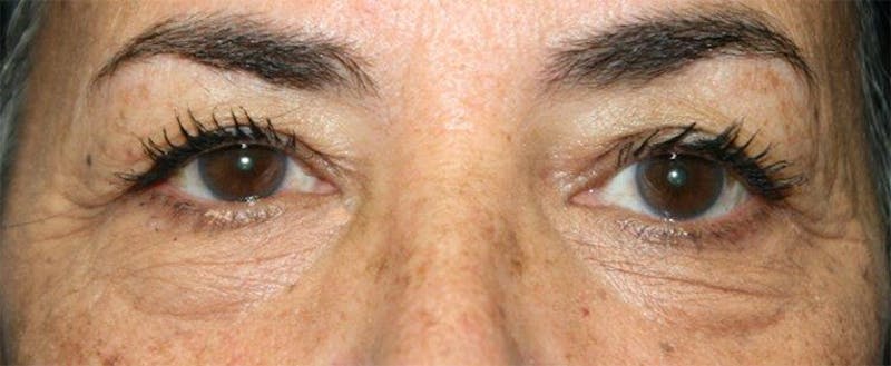 Lower Eyelid Lift Before & After Gallery - Patient 138125 - Image 1