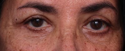 Lower Eyelid Lift Before & After Gallery - Patient 138125 - Image 2