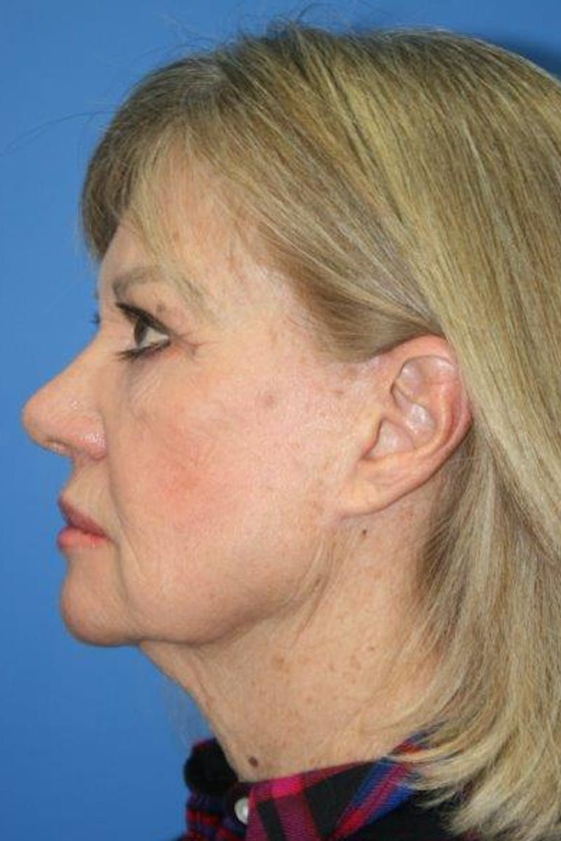 Neck Lift Before & After Gallery - Patient 296040 - Image 1
