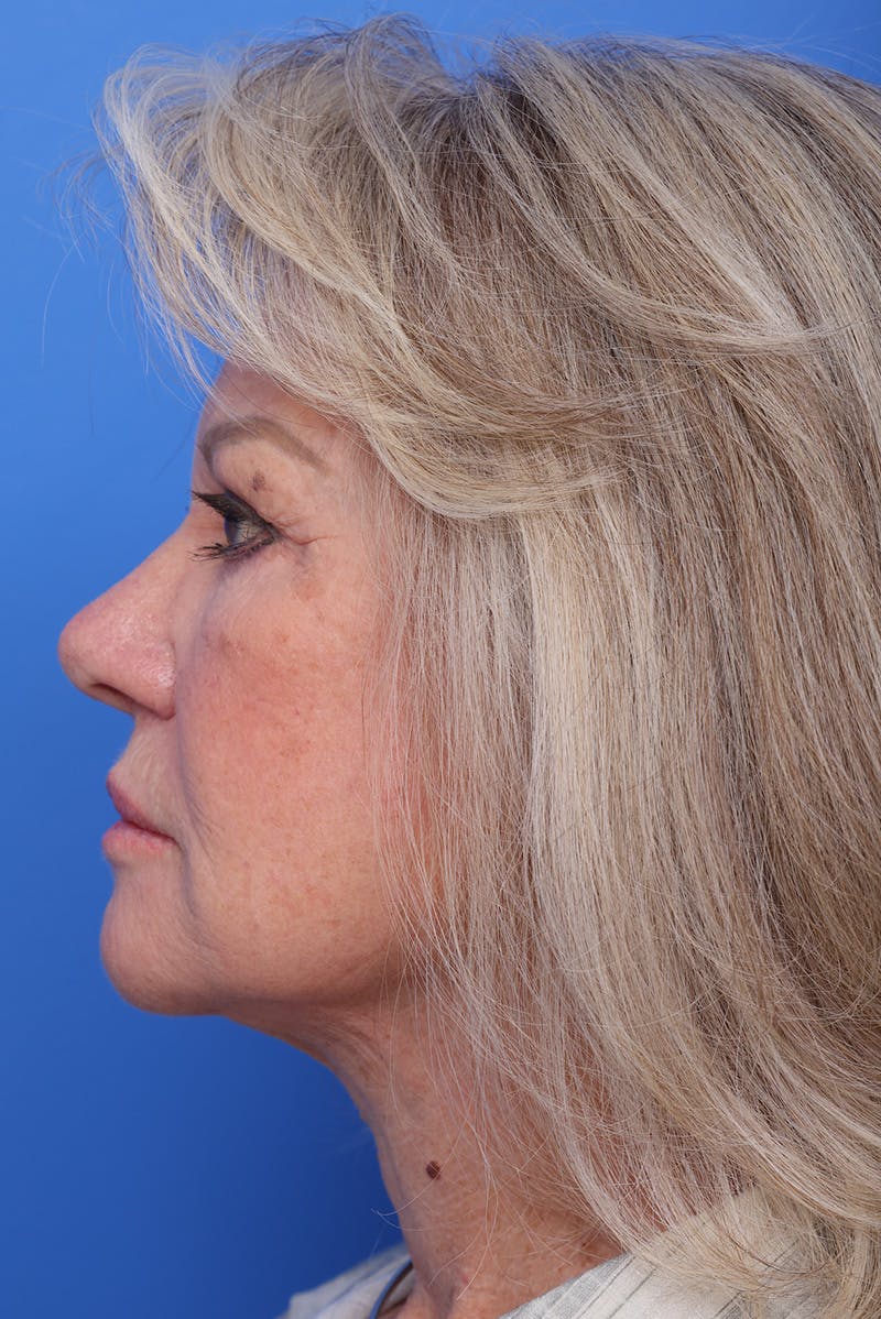 Neck Lift Before & After Gallery - Patient 296040 - Image 2