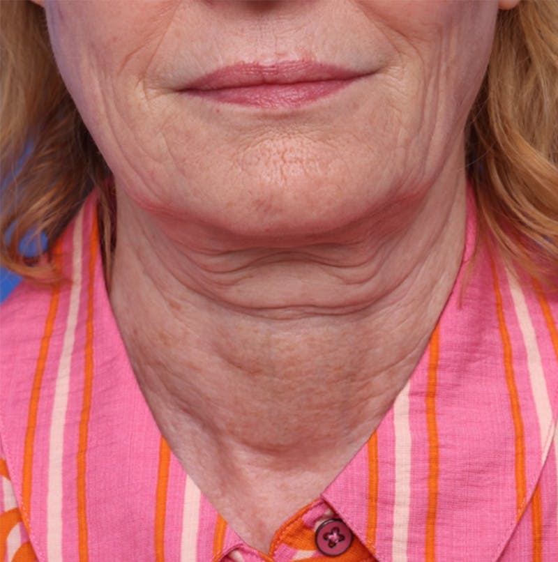Deep Plane Facelift Before & After Gallery - Patient 394726 - Image 3
