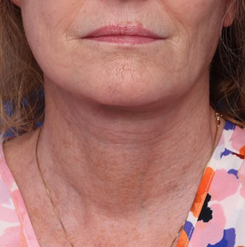 Deep Plane Facelift Before & After Gallery - Patient 394726 - Image 4