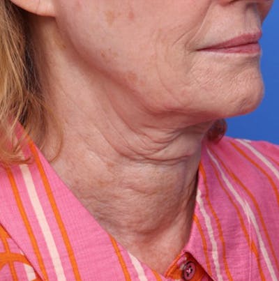 Deep Plane Facelift Before & After Gallery - Patient 394726 - Image 1
