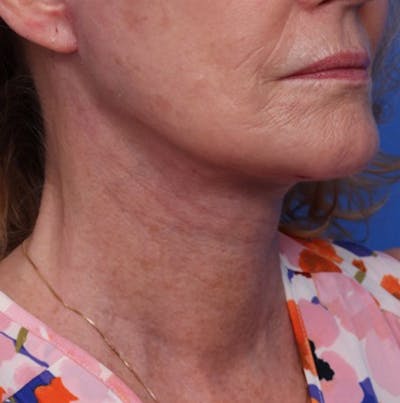 Deep Plane Facelift Before & After Gallery - Patient 394726 - Image 2