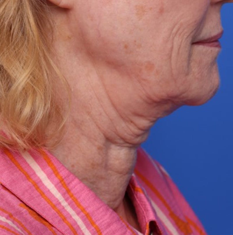 Deep Plane Facelift Before & After Gallery - Patient 394726 - Image 5