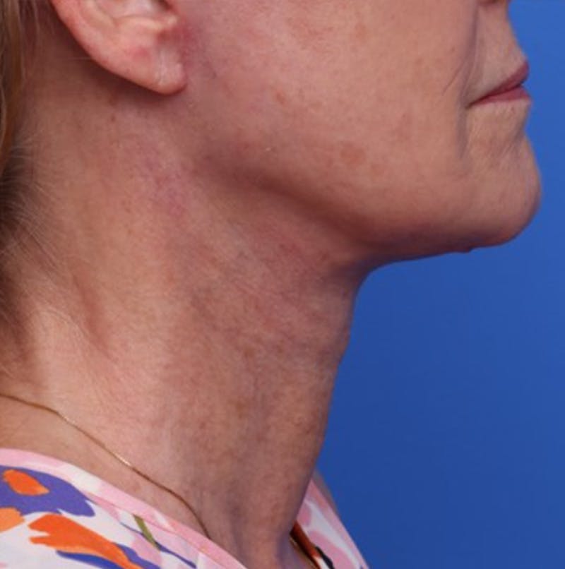 Deep Plane Facelift Before & After Gallery - Patient 394726 - Image 6