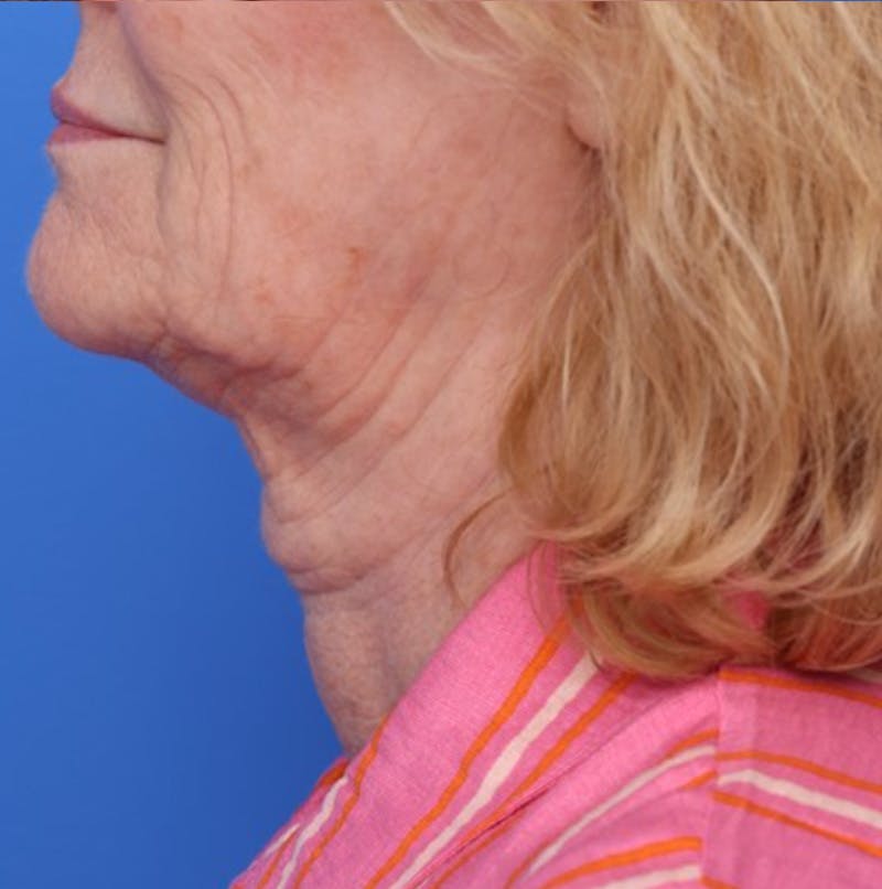 Deep Plane Facelift Before & After Gallery - Patient 394726 - Image 7