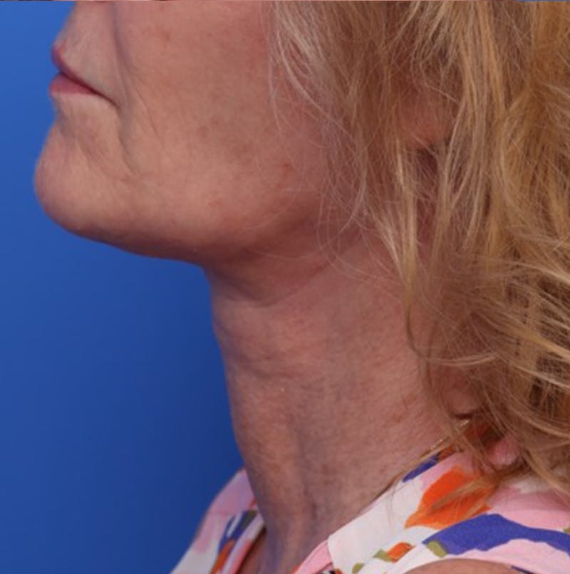 Deep Plane Facelift Before & After Gallery - Patient 394726 - Image 8