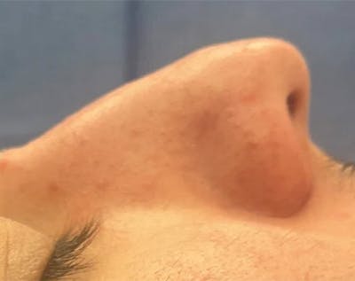 Rhinoplasty Before & After Gallery - Patient 258690 - Image 1