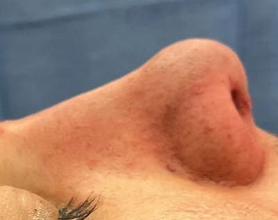 Rhinoplasty Before & After Gallery - Patient 258690 - Image 2