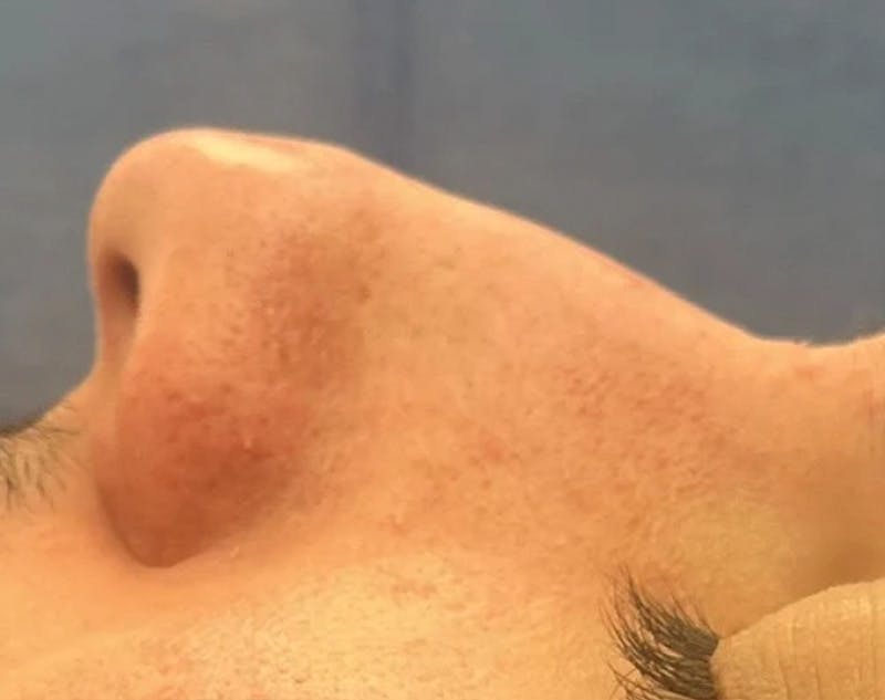 Rhinoplasty Before & After Gallery - Patient 258690 - Image 3