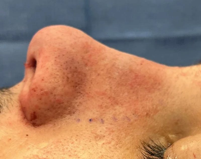 Rhinoplasty Before & After Gallery - Patient 258690 - Image 4
