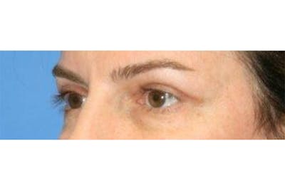 Eyelid Lift Before & After Gallery - Patient 129438 - Image 2