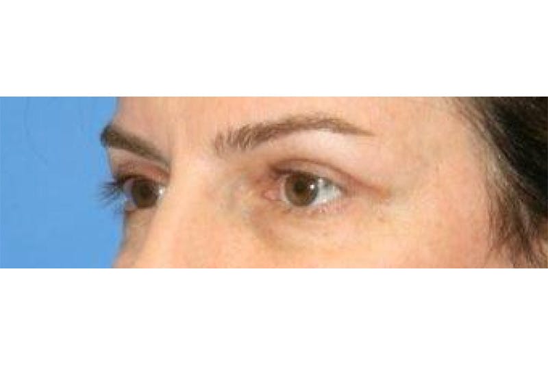Eyelid Lift Before & After Gallery - Patient 129438 - Image 1