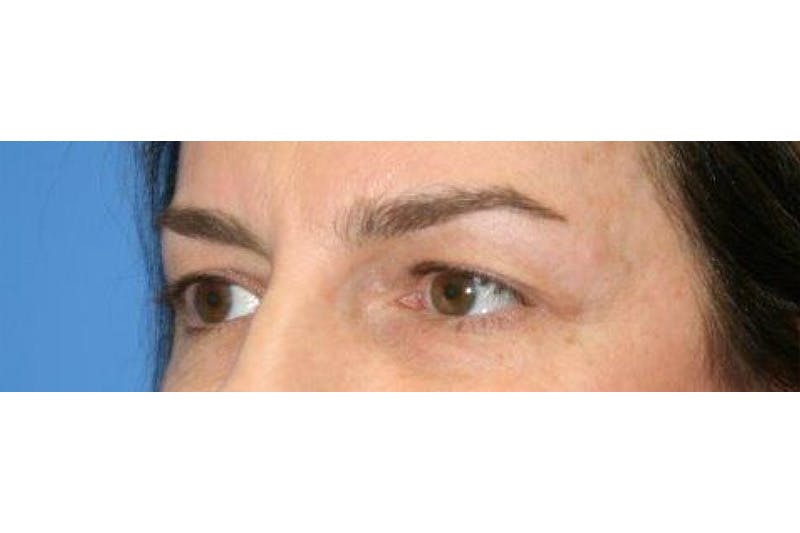 Eyelid Lift Before & After Gallery - Patient 129438 - Image 2