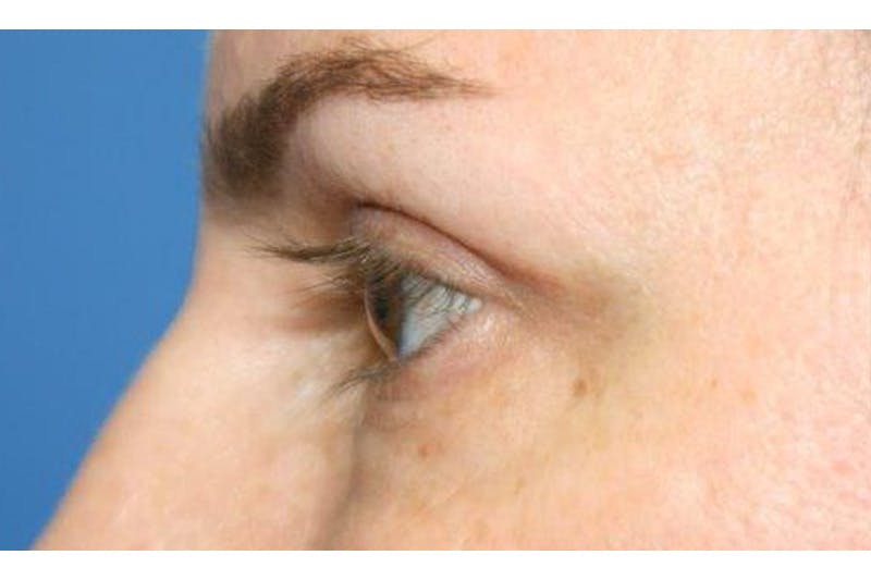 Eyelid Lift Before & After Gallery - Patient 129438 - Image 3