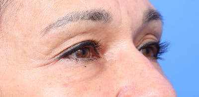Upper Eyelid Lift Before & After Gallery - Patient 745268 - Image 1