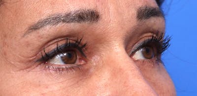 Upper Eyelid Lift Before & After Gallery - Patient 745268 - Image 2