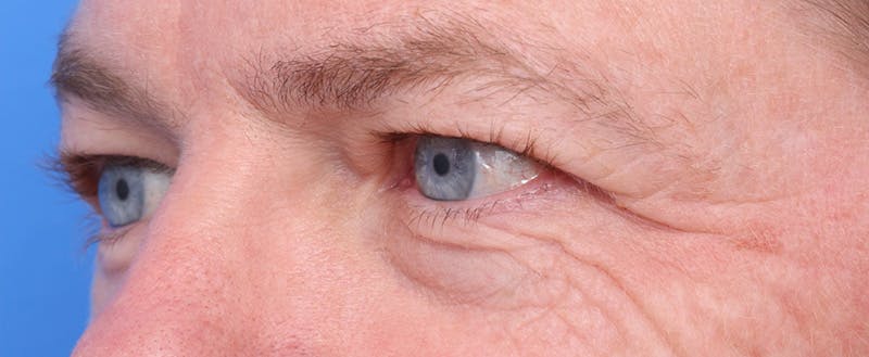 Lower Eyelid Lift Before & After Gallery - Patient 297010 - Image 3