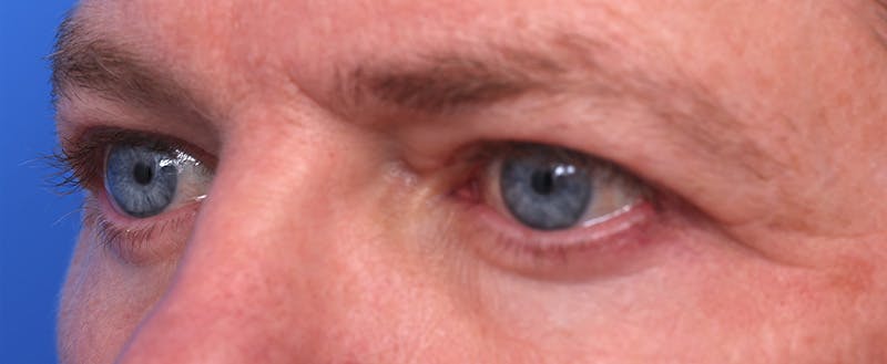 Lower Eyelid Lift Before & After Gallery - Patient 297010 - Image 4