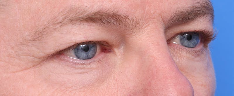 Lower Eyelid Lift Before & After Gallery - Patient 297010 - Image 1