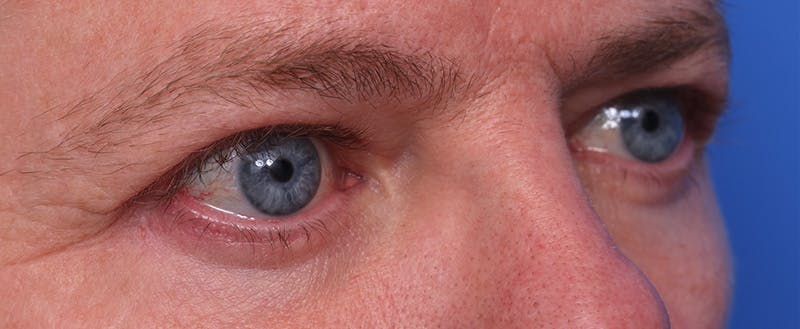Lower Eyelid Lift Before & After Gallery - Patient 297010 - Image 2