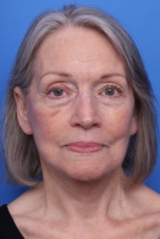 Deep Plane Facelift Before & After Gallery - Patient 317848 - Image 2