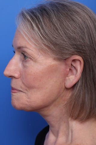 Deep Plane Facelift Before & After Gallery - Patient 317848 - Image 6