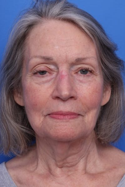 Neck Lift Before & After Gallery - Patient 173155 - Image 1