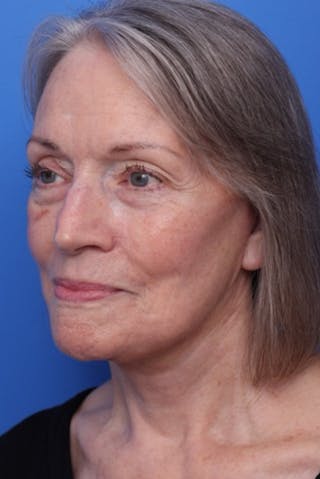 Deep Plane Facelift Before & After Gallery - Patient 317848 - Image 4