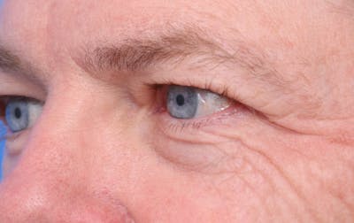 Lower Eyelid Lift Before & After Gallery - Patient 297010 - Image 1