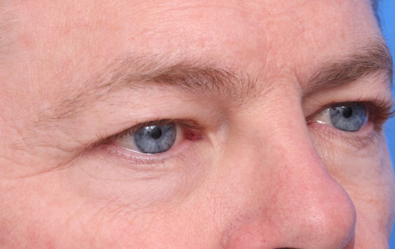 Lower Eyelid Lift Before & After Gallery - Patient 297010 - Image 3