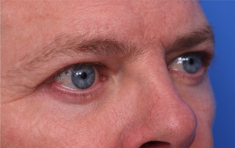 Lower Eyelid Lift Before & After Gallery - Patient 297010 - Image 4