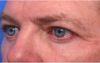 Lower Eyelid Lift Before & After Gallery - Patient 297010 - Image 2