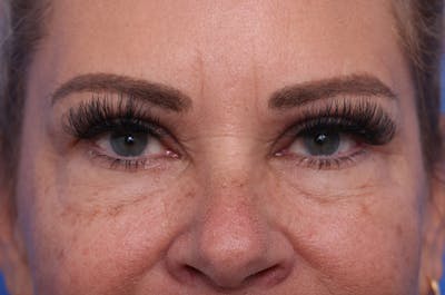 Lower Eyelid Lift Before & After Gallery - Patient 389531 - Image 1