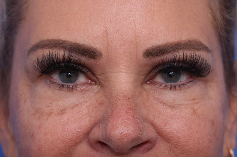 Lower Eyelid Lift Before & After Gallery - Patient 389531 - Image 1