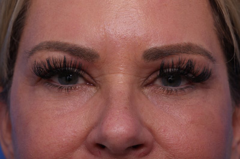 Lower Eyelid Lift Before & After Gallery - Patient 389531 - Image 2