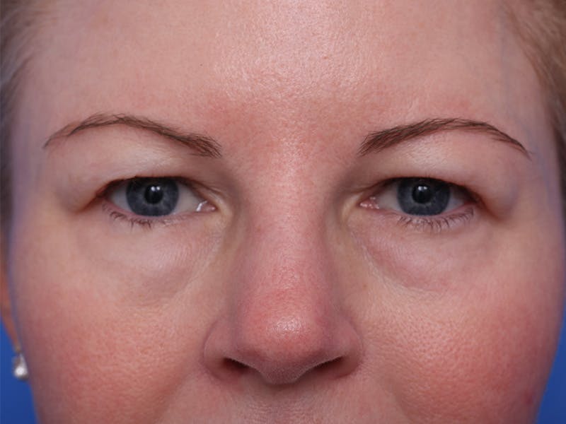 Deep Plane Facelift Before & After Gallery - Patient 316234 - Image 1