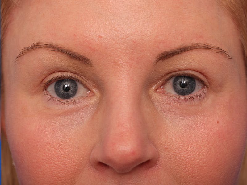 Deep Plane Facelift Before & After Gallery - Patient 316234 - Image 2