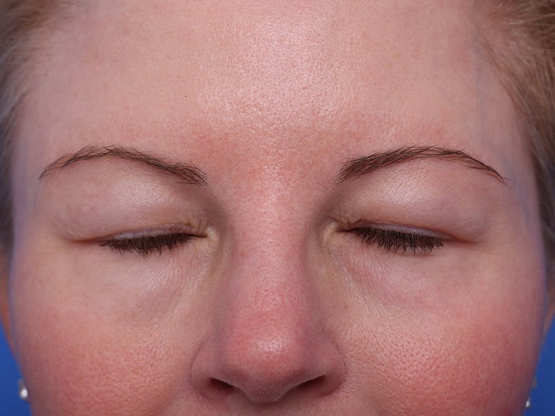 Deep Plane Facelift Before & After Gallery - Patient 316234 - Image 3