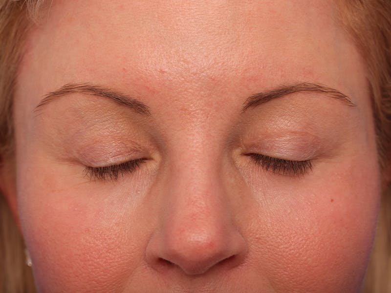 Deep Plane Facelift Before & After Gallery - Patient 316234 - Image 4
