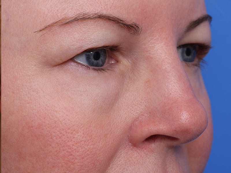 Deep Plane Facelift Before & After Gallery - Patient 316234 - Image 5