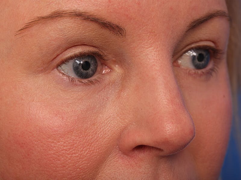 Deep Plane Facelift Before & After Gallery - Patient 316234 - Image 6