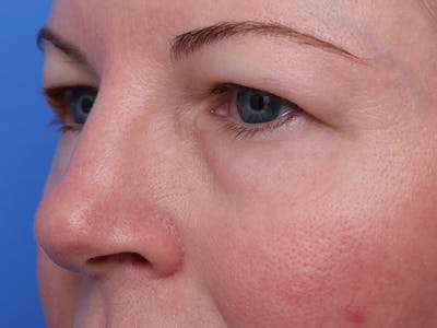 Upper Eyelid Lift Before & After Gallery - Patient 427468 - Image 1