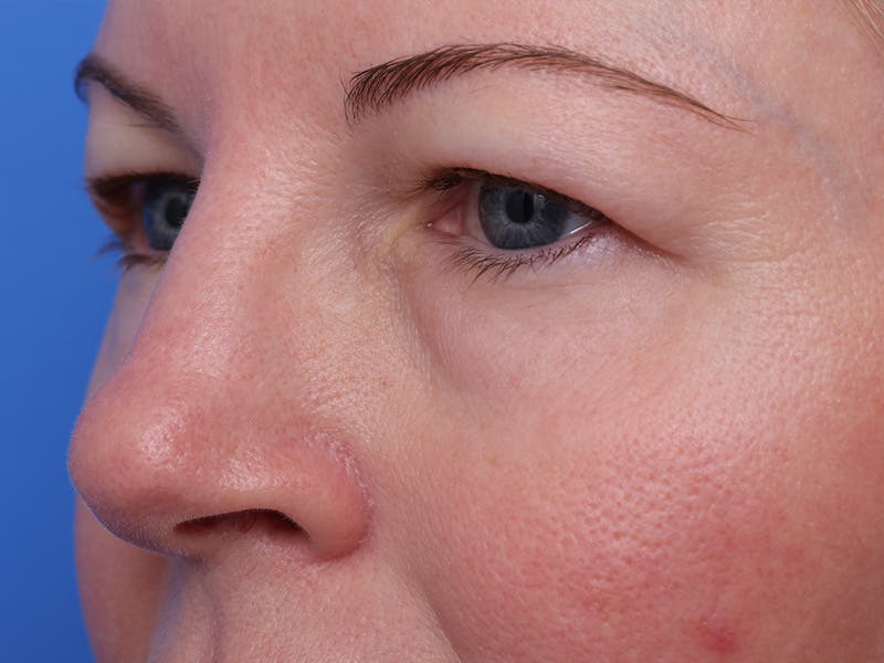 Deep Plane Facelift Before & After Gallery - Patient 316234 - Image 7