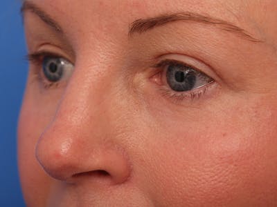 Upper Eyelid Lift Before & After Gallery - Patient 427468 - Image 2