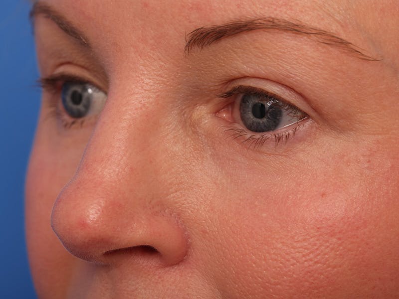Deep Plane Facelift Before & After Gallery - Patient 316234 - Image 8