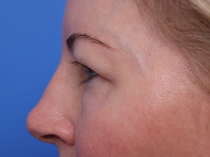 Deep Plane Facelift Before & After Gallery - Patient 316234 - Image 9