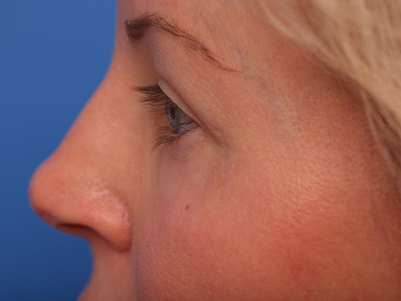Deep Plane Facelift Before & After Gallery - Patient 316234 - Image 10