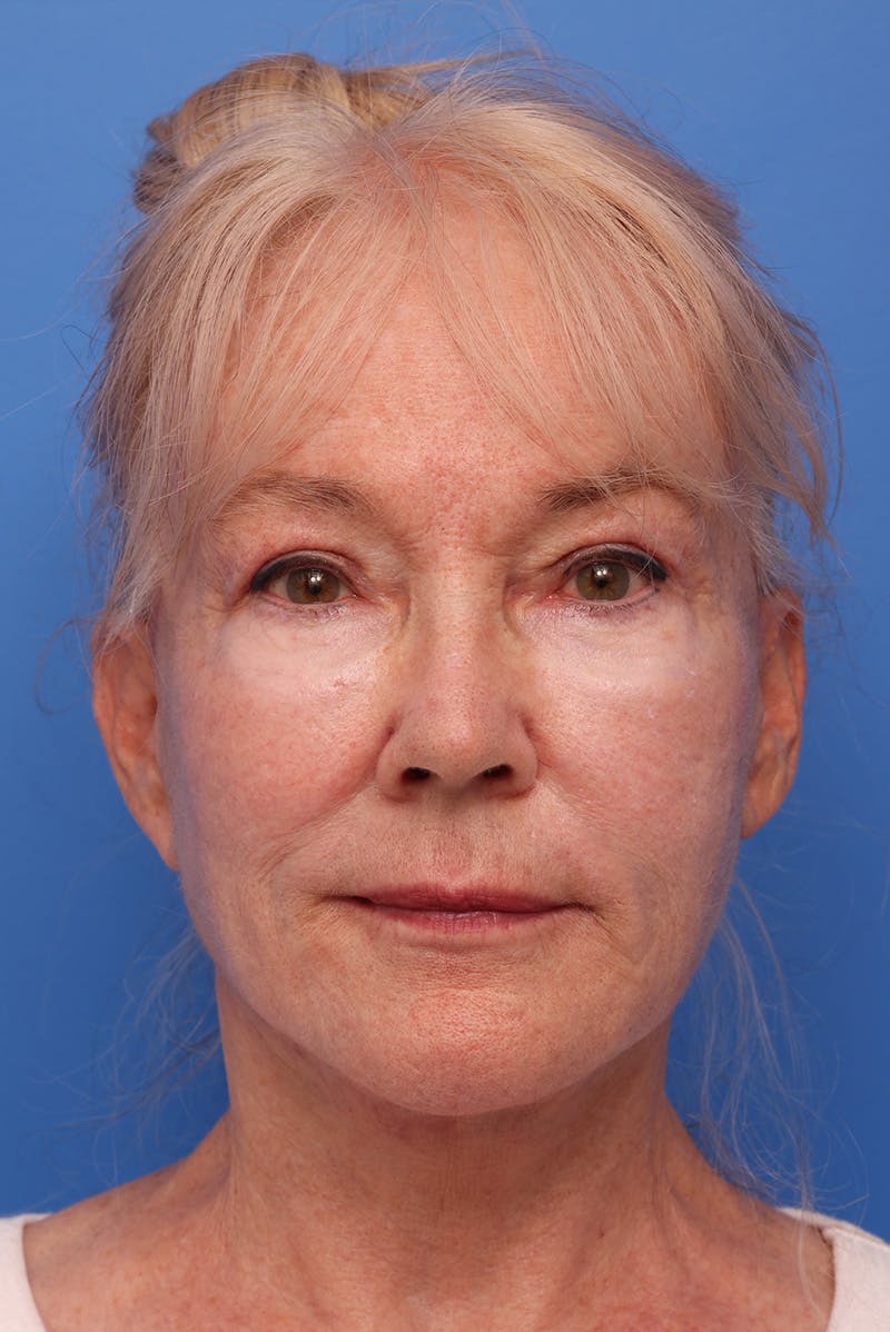 Neck Lift Before & After Gallery - Patient 167665 - Image 2